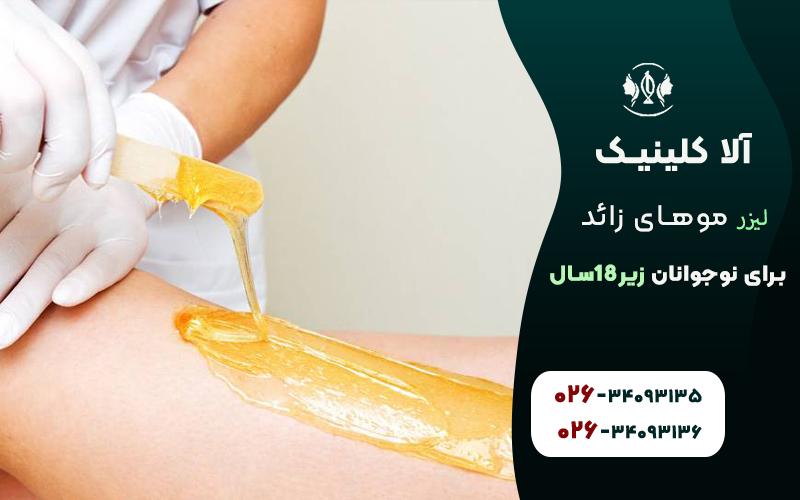 لیزر مو های زائد برای نوجوانان