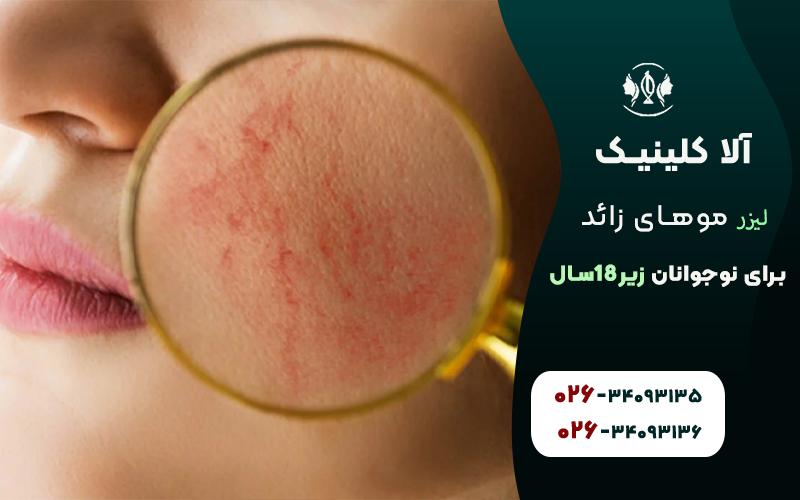 لیزر مو های زائد برای نوجوانان؛ سن زیر 18 سال