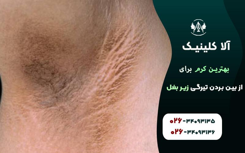 معرفی بهترین کرم برای از بین بردن تیرگی زیر بغل