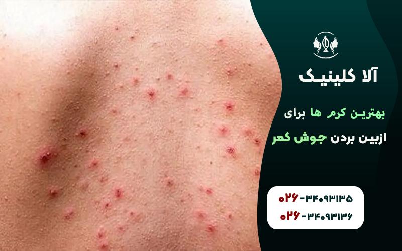 معرفی بهترین کرمها برای از بین بردن جوش کمر