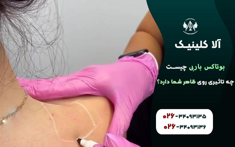 بوتاکس باربی چیست؟ چه تاثیری روی ظاهر شما دارد