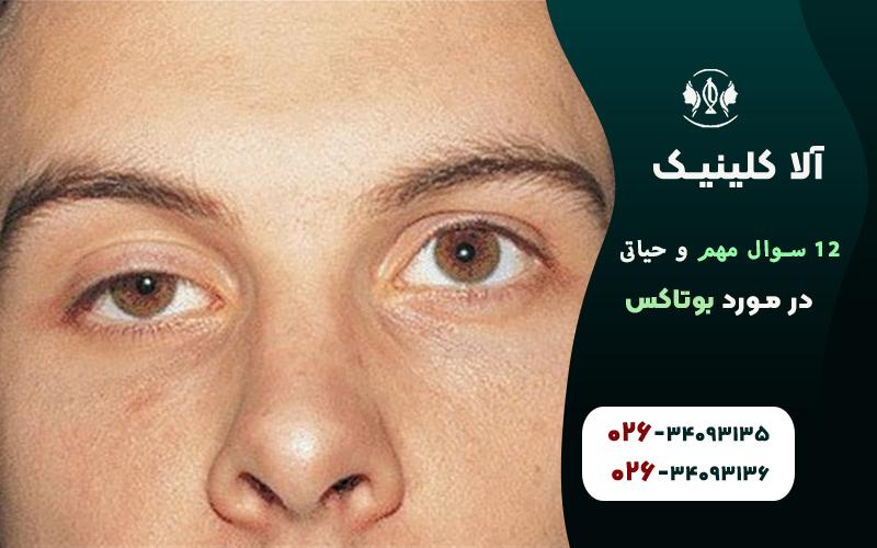 اگر بوتاکس بد تزریق شود چه میشود