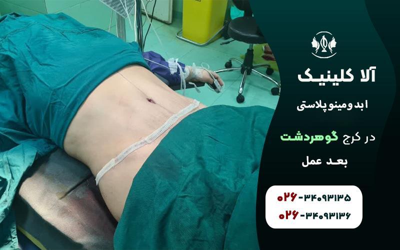 ابدومینوپلاستی بعد عمل