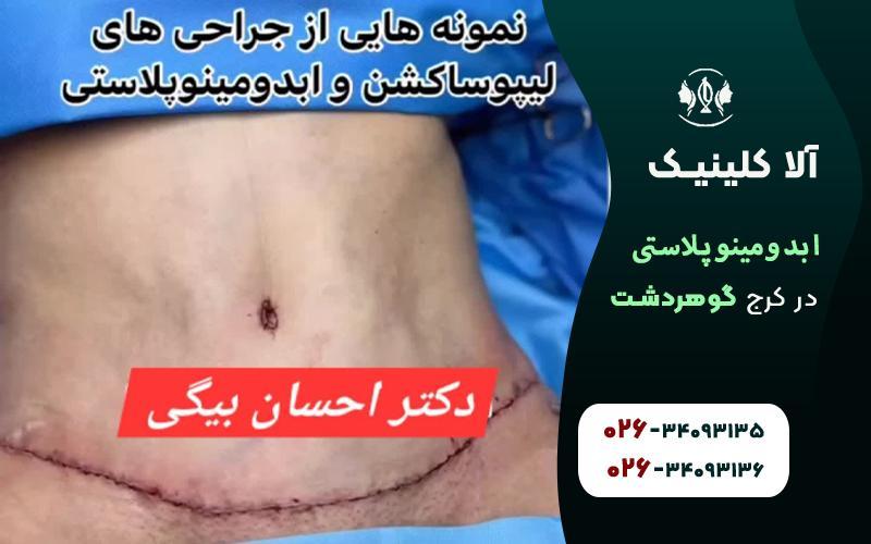 ابدومینوپلاستی در کرج