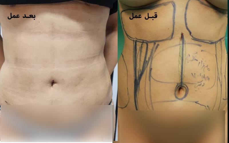 ابدومینوپلاستی قبل و بعد از عمل
