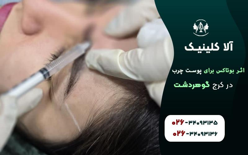 تاثیر بوتاکس بر پوست چرب