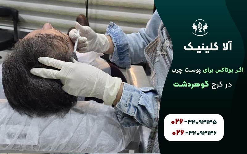 تاثیرات بوتاکس برای پوست چرب