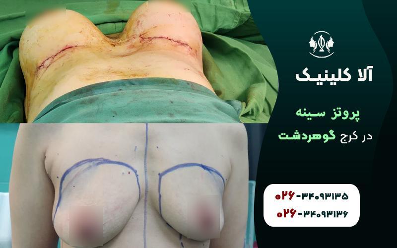 عمل پروتز سینه در کرج