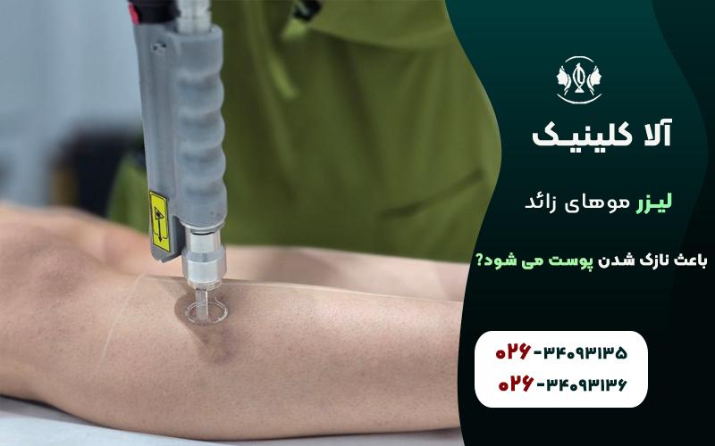 لیزر موهای زائد و نازک شدن پوست