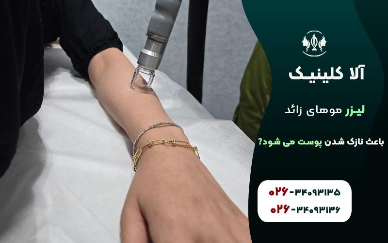 لیزر موهای زائد باعث نازک شدن پوست می شود