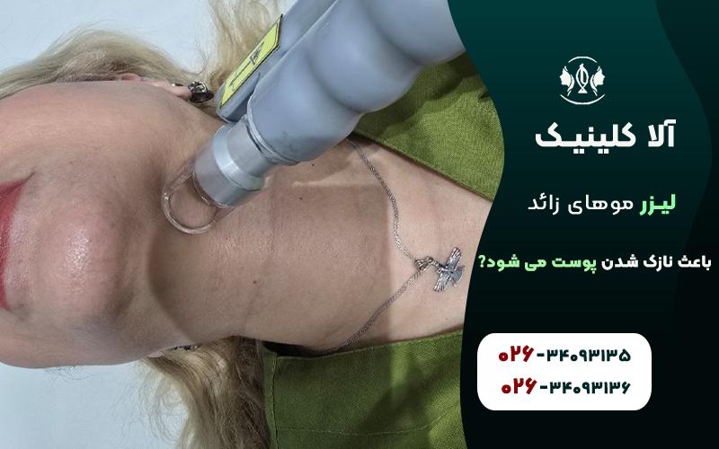 آیا لیزر موهای زائد باعث نازک شدن پوست می شود