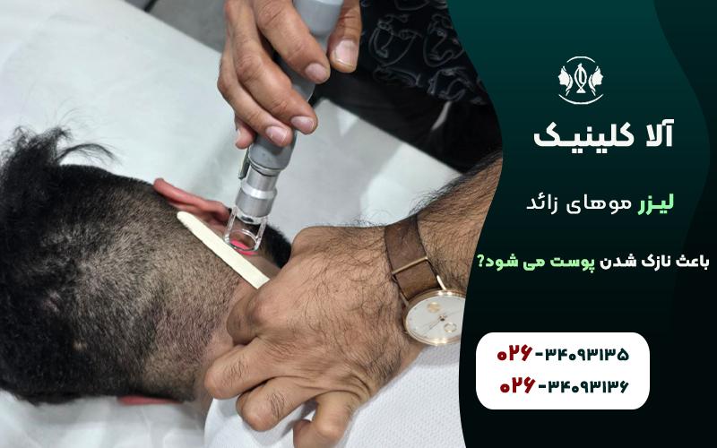 تاثیر لیزر موهای زائد بر نازک شدن پوست