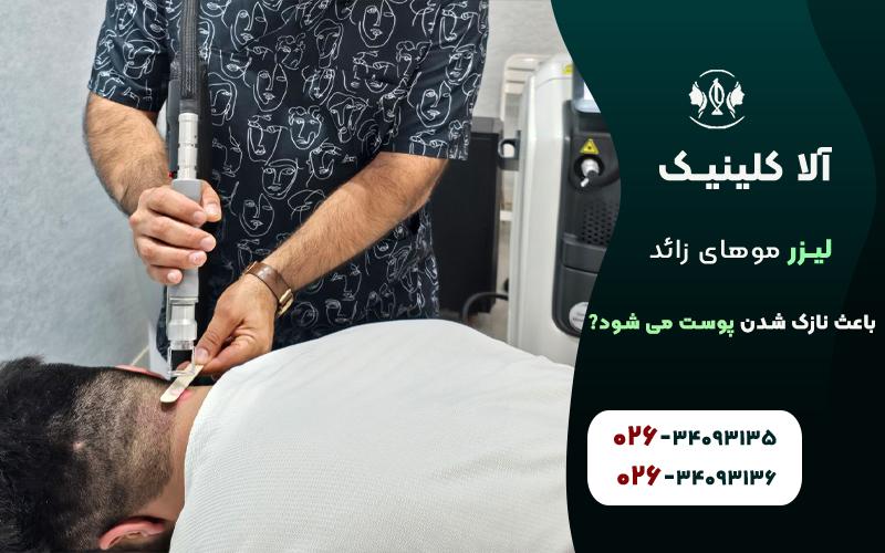 لیزر موهای زائد باعث نازک شدن پوست می شود