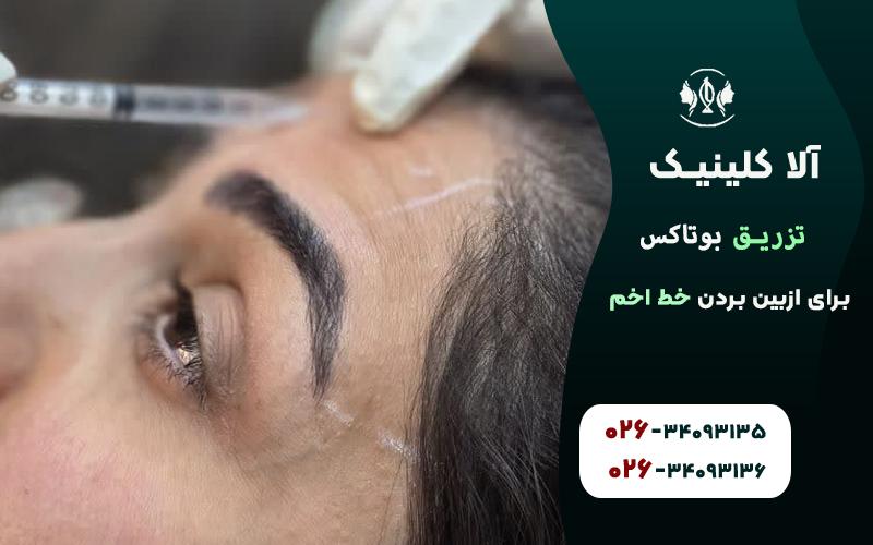 بوتاکس برای ازبین بردن خط اخم