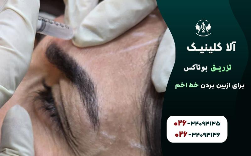 بوتاکس برای ازبین بردن خط اخم