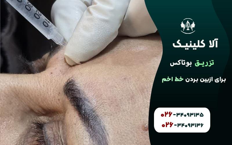 ازبین بردن خط اخم با تزریق بوتاکس