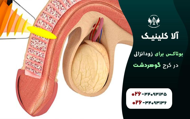 بوتاکس برای درمان زود انزالی