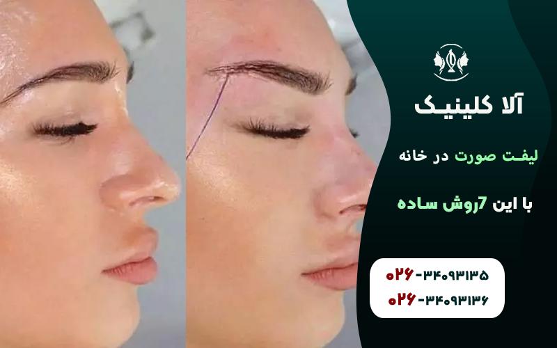 لیفت پوست اطراف چشم و شقیقه قبل و بعد