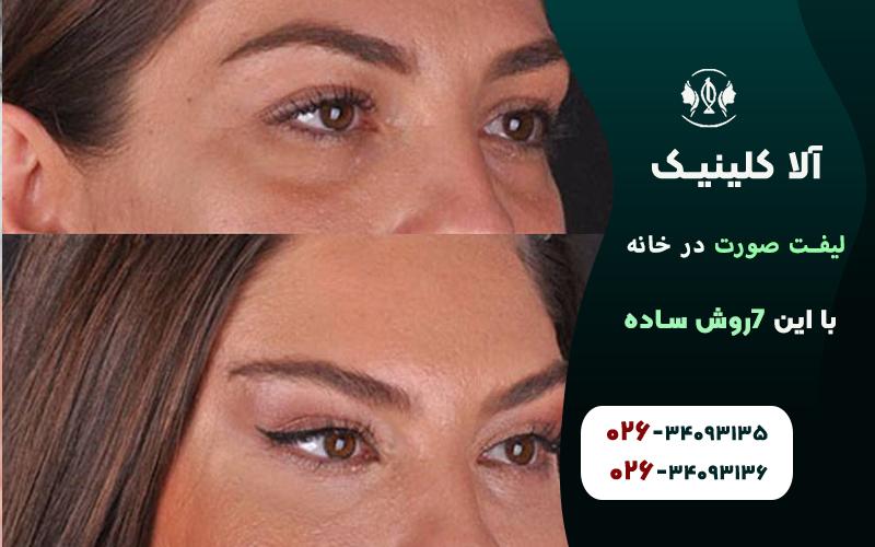 لیفت صورت قبل و بعد