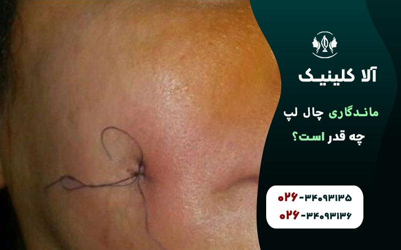 ماندگاری چال لپ چقدر است