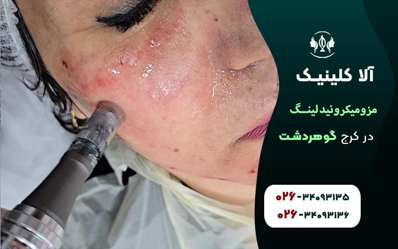 مزومیکرونیدلینگ صورت