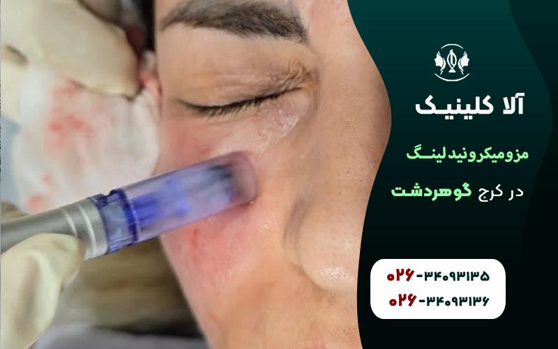 مزومیکرونیدلینگ