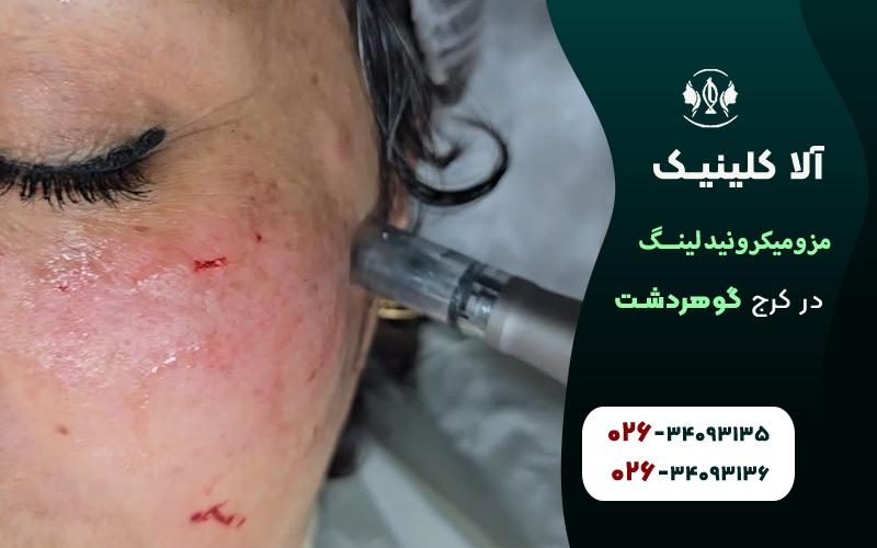 هزینه مزومیکرونیدلینگ