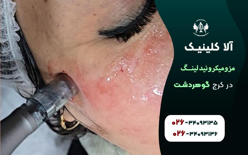 مزومیکرونیدلینگ