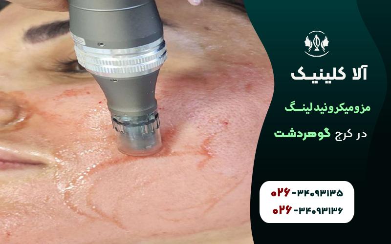 قیمت مزومیکرونیدلینگ