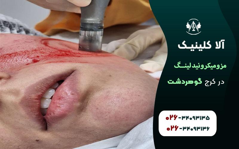 مزومیکرونیدلینگ در کرج