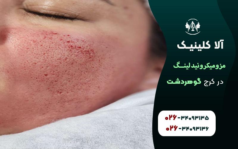 مزومیکرونیدلینگ