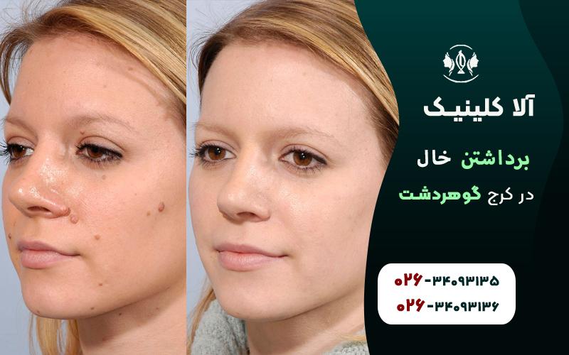 خال برداری قبل و بعد