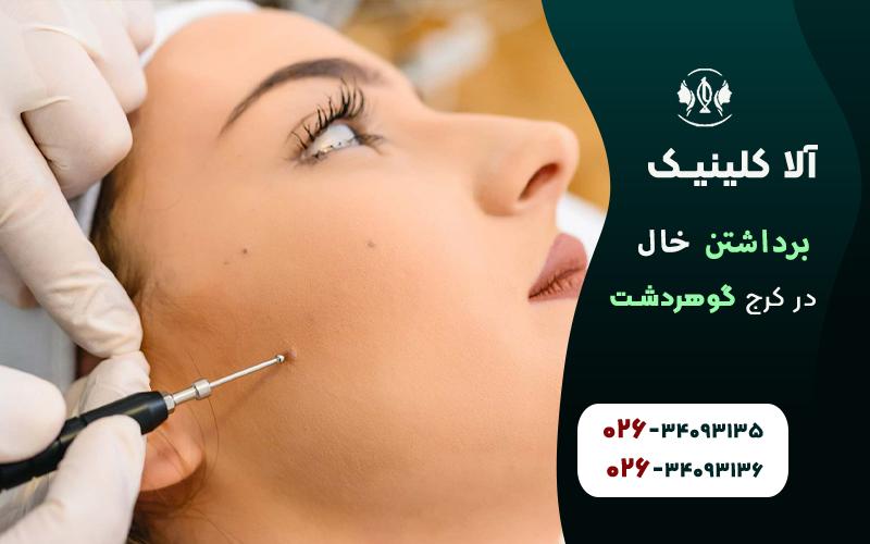 برداشتن خال در کرج گوهردشت