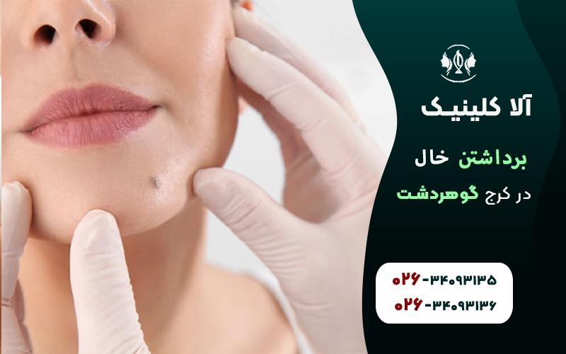 خال برداری در کرج گوهردشت