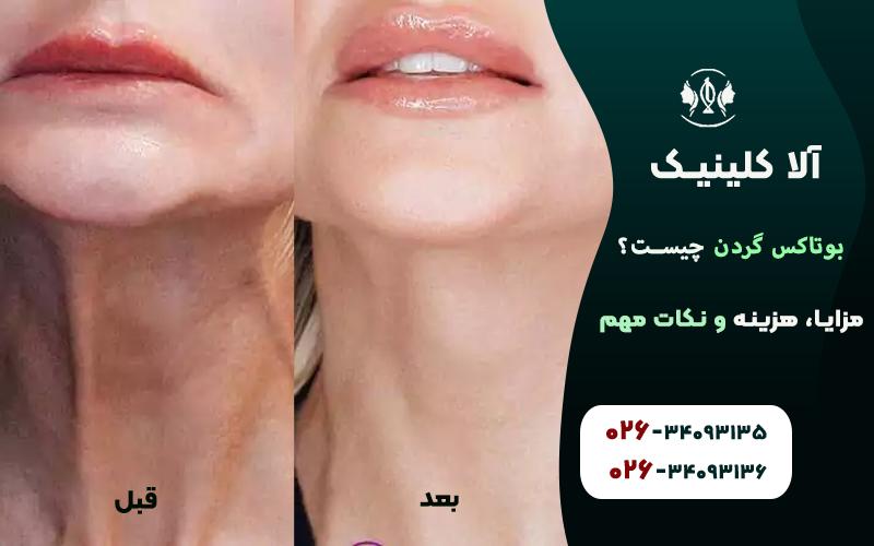 بوتاکس گردن قبل و بعد از تزریق