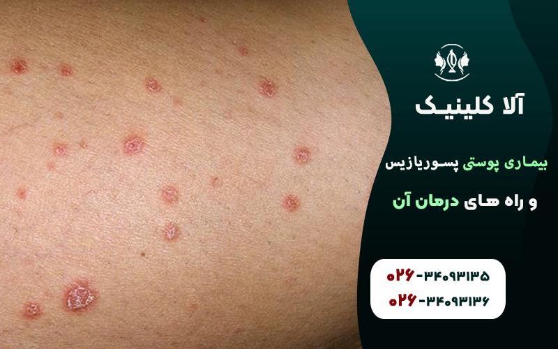 پسوریازیس قطره ای