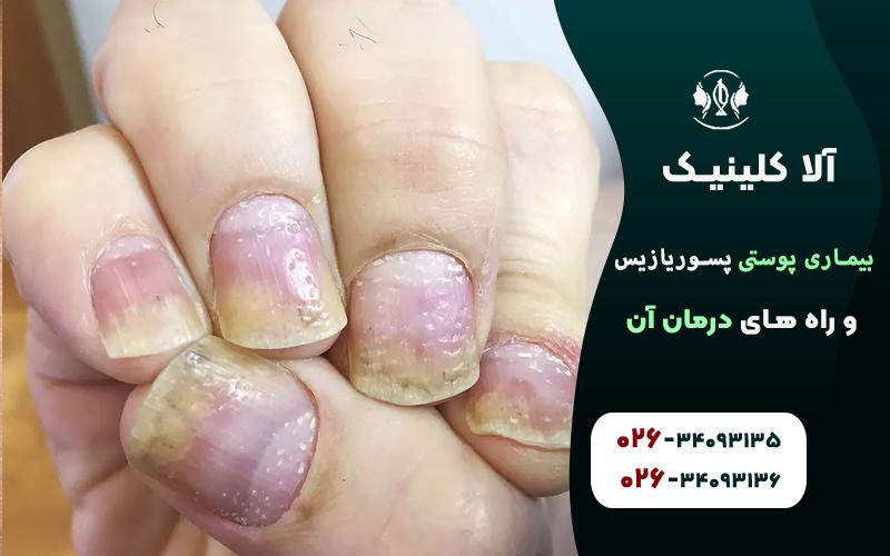 پسوریازیس ناخن
