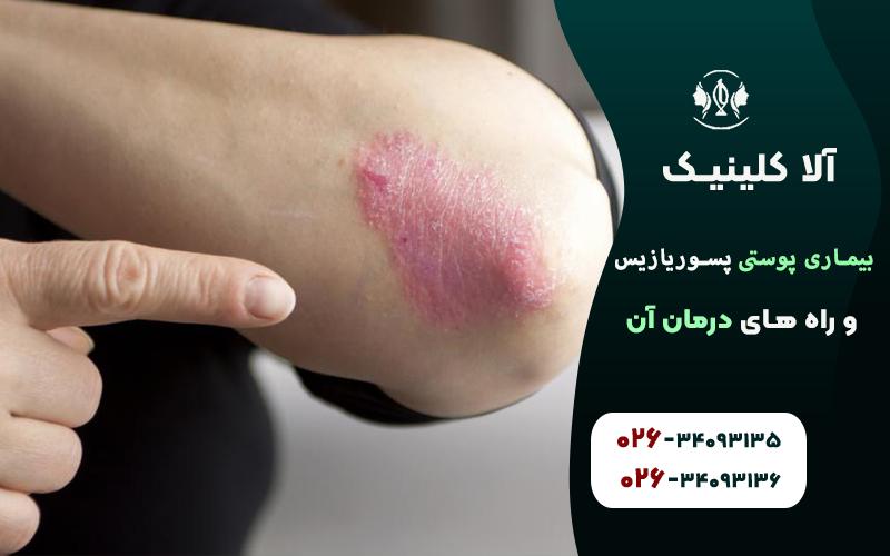 پسوریازیس پوسچولار