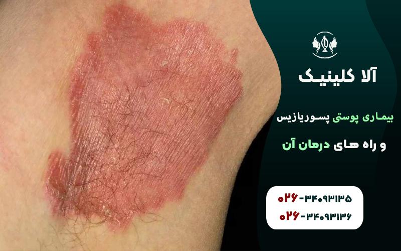 پسوریازیس معکوس