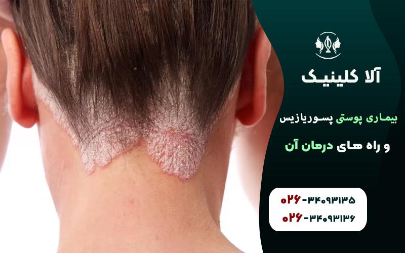 پسوریازیس پلاکی
