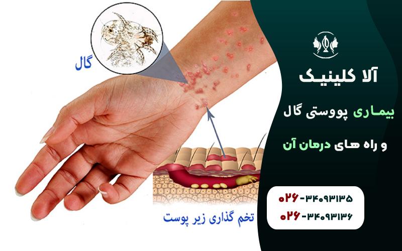 بیماری پوستی گال و راه‌های درمان آن