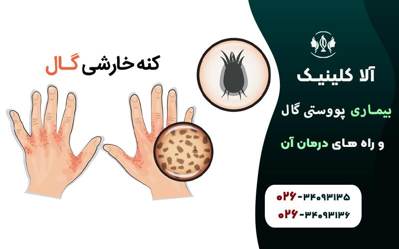 آشنایی با بیماری پوستی گال