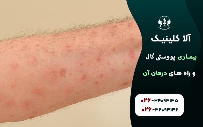 علائم بیماری پوستی گال