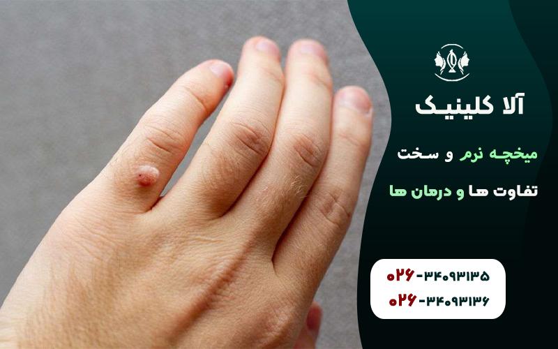 زگیل