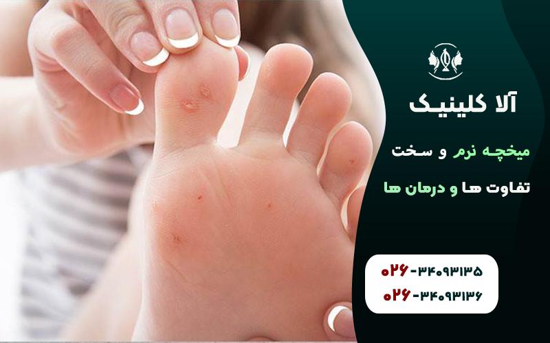 تفاوت میخچه نرم و سخت