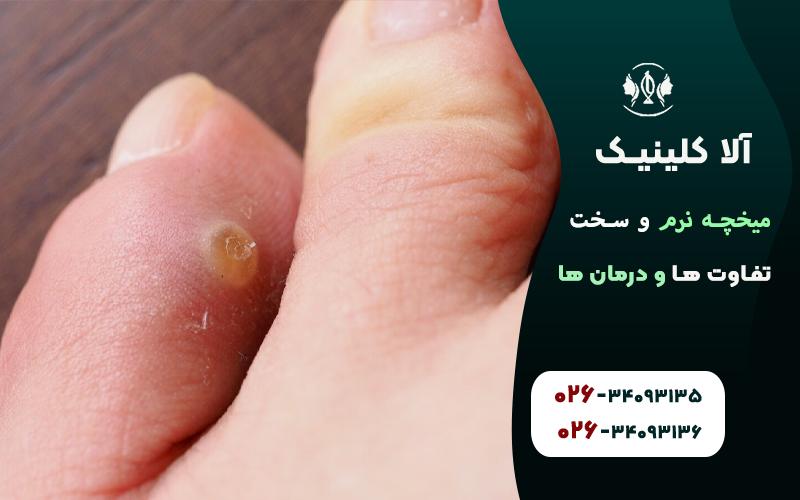 میخچه نرم و سخت؛ تفاوت ها و درمان ها