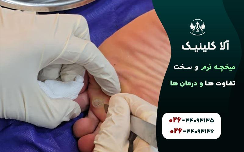 میخچه نرم و سخت؛ تفاوت ها و درمان ها