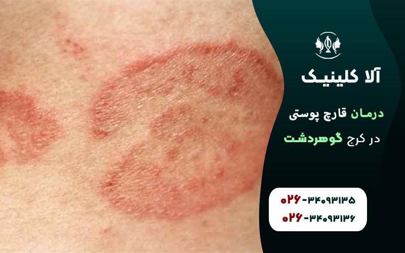 قارچ پوستی چیست