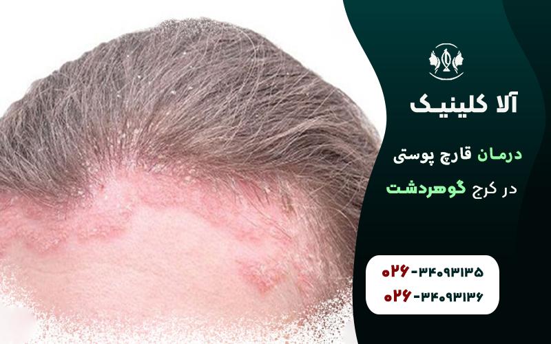 درمان قارچ پوستی در کرج