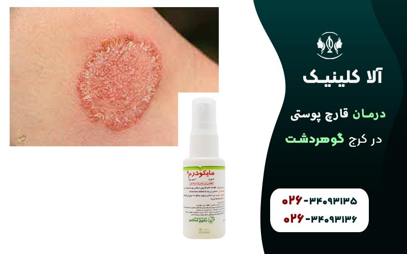 درمان قارچ پوستی در کرج